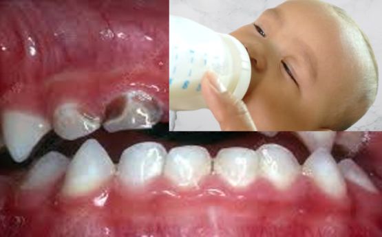 baby bottle caries